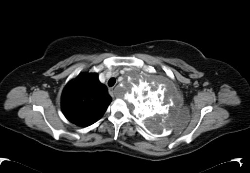 File:Chondrosarcoma - chest wall (Radiopaedia 65192-74199 C 12).jpg