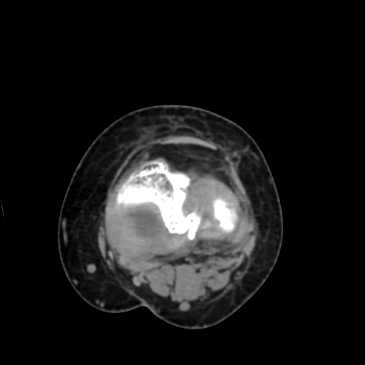 Chondrosarcoma - femur (Radiopaedia 64187-72954 Axial non-contrast 57).jpg