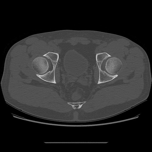 File:Chondrosarcoma of iliac wing (Radiopaedia 63861-72599 Axial bone window 98).jpg