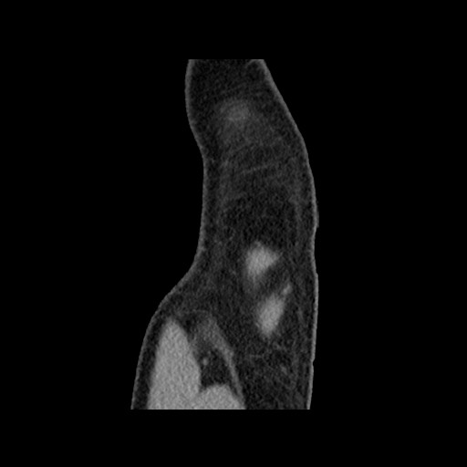 Chondrosarcoma of iliac wing (Radiopaedia 63861-72599 F 13).jpg