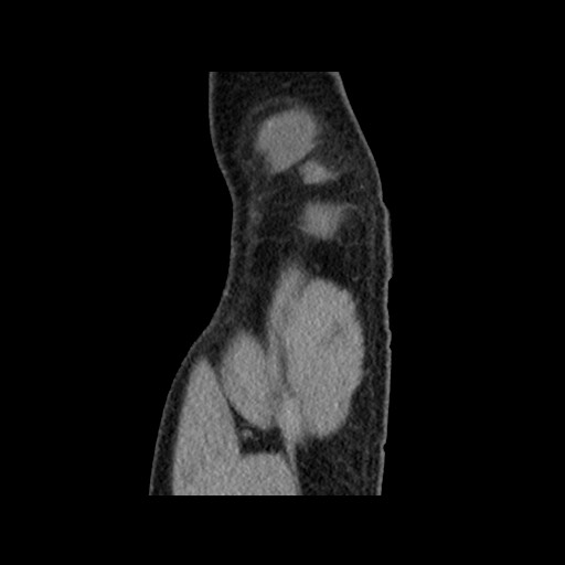 Chondrosarcoma of iliac wing (Radiopaedia 63861-72599 F 16).jpg