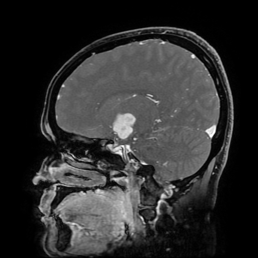 File:Chordoid glioma of third ventricle (Radiopaedia 91612-109340 F 92).jpg