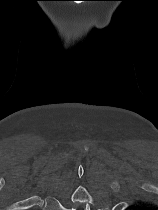 Chordoma (C4 vertebra) (Radiopaedia 47561-52188 Coronal bone window 67).png