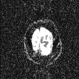 File:Choroid plexus xanthogranuloma - unilateral (Radiopaedia 85632-101393 Axial ADC 59).jpg