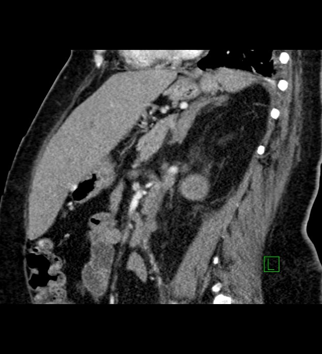 Chromophobe renal cell carcinoma (Radiopaedia 84239-99519 D 51).jpg