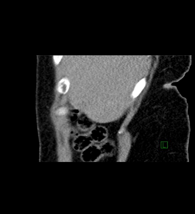 Chromophobe renal cell carcinoma (Radiopaedia 84290-99582 D 87).jpg
