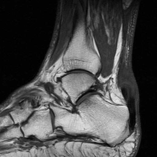 File:Chronic Achilles tendon rupture (Radiopaedia 15262-15100 Sagittal T1 5).jpg