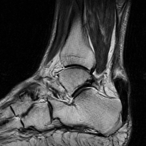 File:Chronic Achilles tendon rupture (Radiopaedia 15262-15100 Sagittal T2 5).jpg