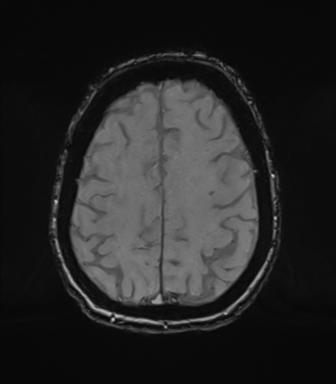 Chronic hypertensive encephalopathy (Radiopaedia 72844-83495 Axial SWI magnitude 65).png