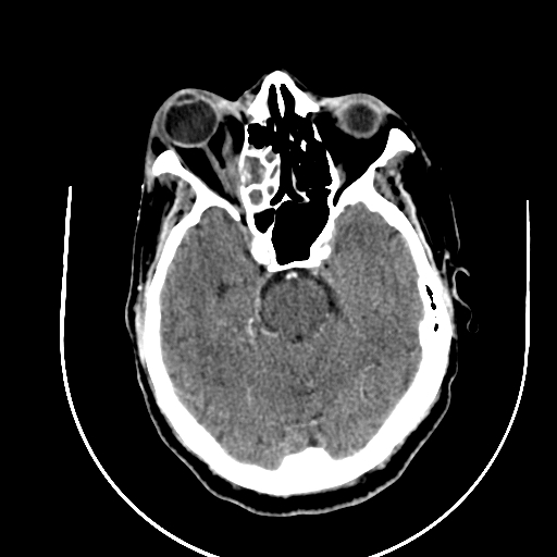 Chronic invasive fungal sinusitis (Radiopaedia 91563-109286 B 34).jpg