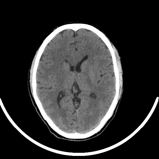 Chronic invasive fungal sinusitis with intraorbital and intracranial extension (Radiopaedia 56387-63046 Axial non-contrast 213).jpg