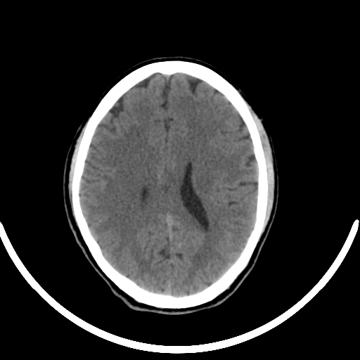 Chronic invasive fungal sinusitis with intraorbital and intracranial extension (Radiopaedia 56387-63046 Axial non-contrast 239).jpg