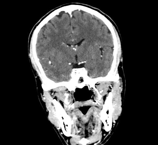 Chronic invasive fungal sinusitis with intraorbital and intracranial extension (Radiopaedia 56387-63046 C 189).jpg