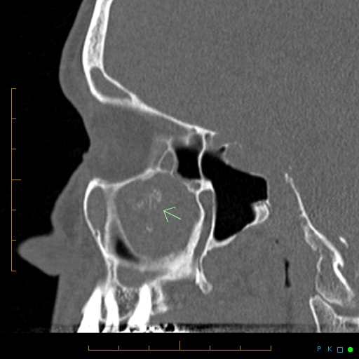 File:Chronic invasive fungal sinusitis with mycetoma (Radiopaedia 27430-27626 Sagittal bone window 1).jpg