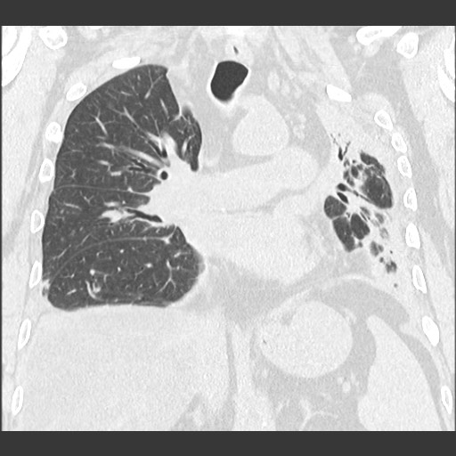 File:Chronic lung allograft dysfunction - restrictive form (Radiopaedia 60595-68316 Coronal lung window 57).jpg