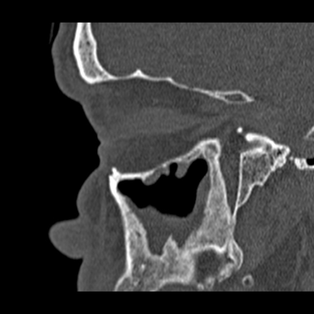 Chronic maxillary sinusitis (Radiopaedia 27879-28116 Sagittal bone window 40).jpg
