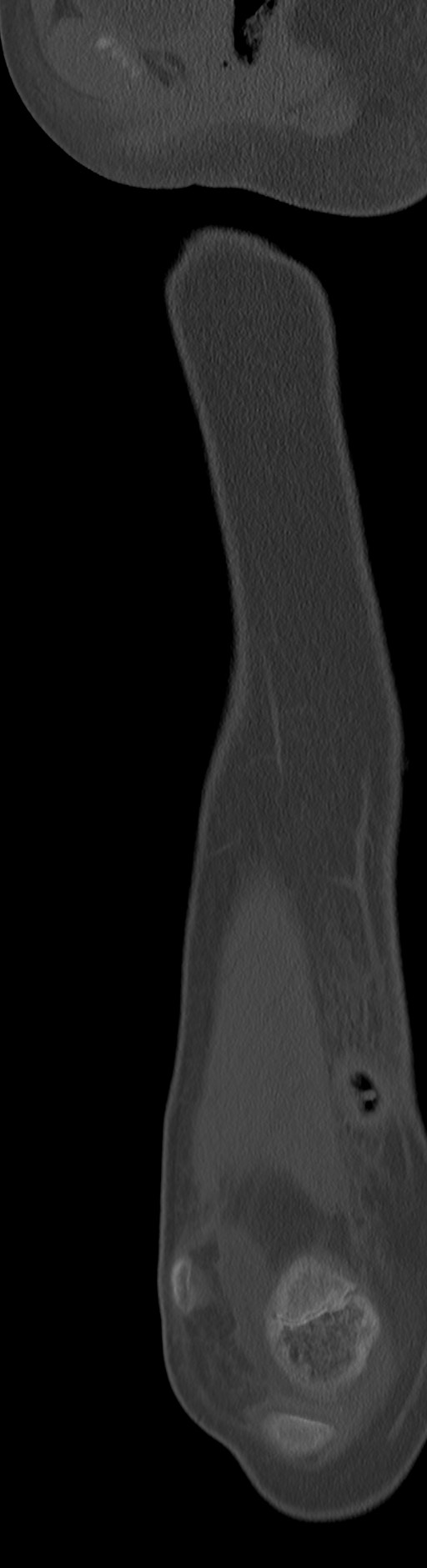 Chronic ostemyelitis of the femur with long sinus tract (Radiopaedia 74947-85982 Sagittal bone window 70).jpg