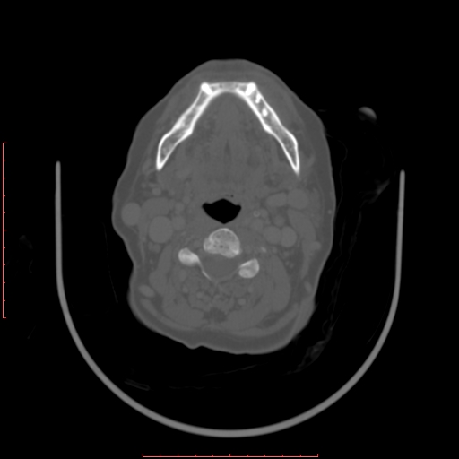 Chronic osteomyelitis - maxilla (Radiopaedia 23783-23927 Axial bone window 30).jpg