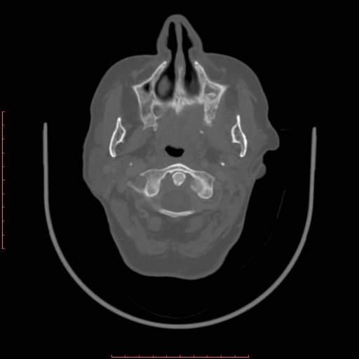 Chronic osteomyelitis - maxilla (Radiopaedia 23783-23927 Axial bone window 89).jpg