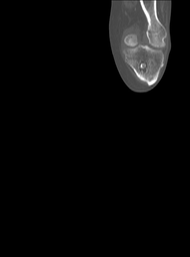 Chronic osteomyelitis - tibia (with sequestrum) (Radiopaedia 73273-84090 Coronal non-contrast 11).jpg