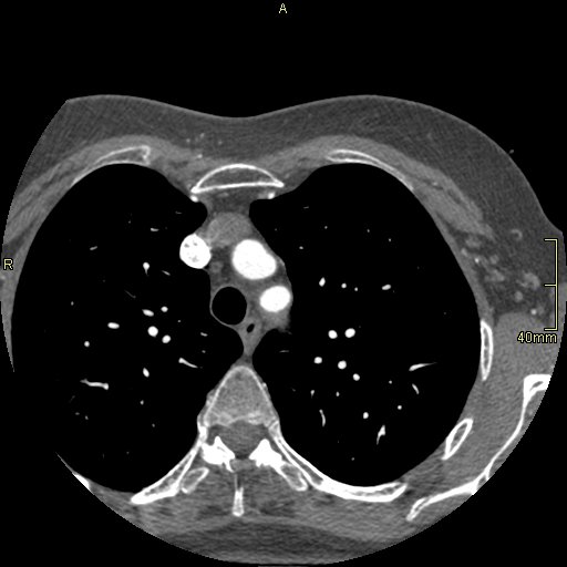 Chronic pulmonary embolism (Radiopaedia 73073-85094 Axial C+ CTPA 9).jpg