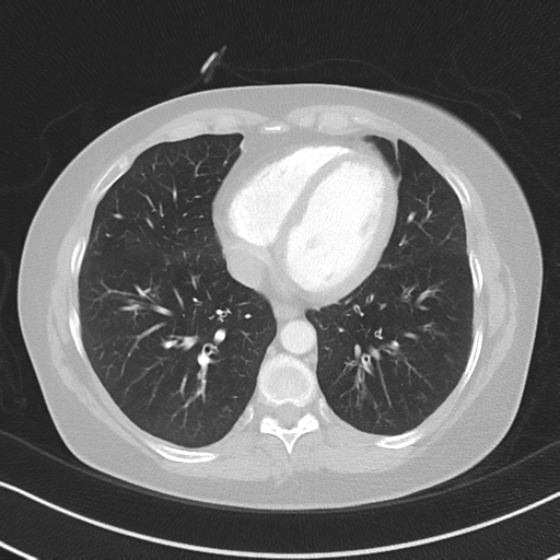 Chronic pulmonary embolus (Radiopaedia 39129-41341 Axial lung window 43).png