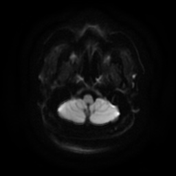 Chronic submandibular sialadenitis (Radiopaedia 61852-69885 Axial DWI 6).jpg