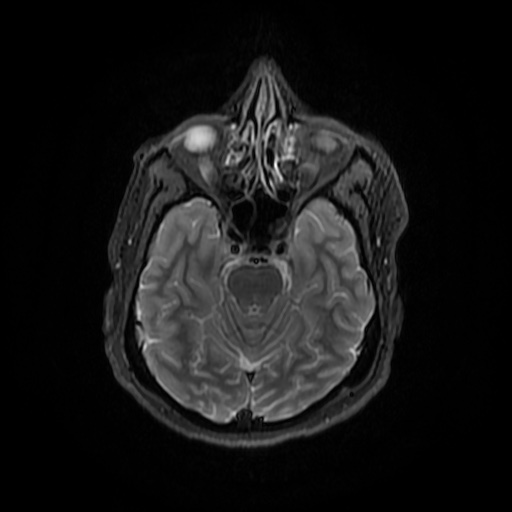 File:Chronic submandibular sialadenitis (Radiopaedia 61852-69885 Axial STIR 1).jpg