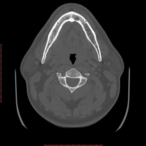 Chronic submandibular sialolithiasis (Radiopaedia 69817-79814 Axial bone window 64).jpg