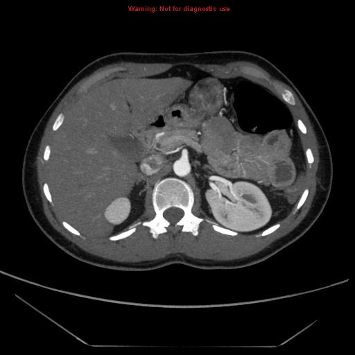 File:Circumaortic left renal vein (Radiopaedia 9069-9792 A 10).jpg
