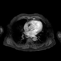 Cirrhosis and hepatocellular carcinoma in the setting of hemochromatosis (Radiopaedia 75394-86594 Axial T1 C+ fat sat 261).jpg