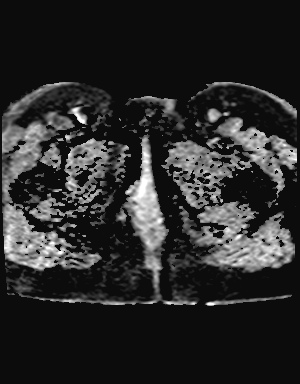 File:Class II Mullerian duct anomaly- unicornuate uterus with rudimentary horn and non-communicating cavity (Radiopaedia 39441-41755 Axial ADC 30).jpg