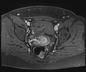 File:Class II Mullerian duct anomaly- unicornuate uterus with rudimentary horn and non-communicating cavity (Radiopaedia 39441-41755 Axial T1 fat sat 81).jpg