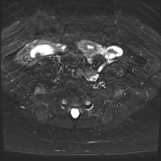 File:Class II Mullerian duct anomaly- unicornuate uterus with rudimentary horn and non-communicating cavity (Radiopaedia 39441-41755 Axial T2 fat sat 5).jpg