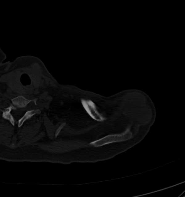 Clear cell chondrosarcoma - humerus (Radiopaedia 63104-71612 Axial bone window 12).jpg