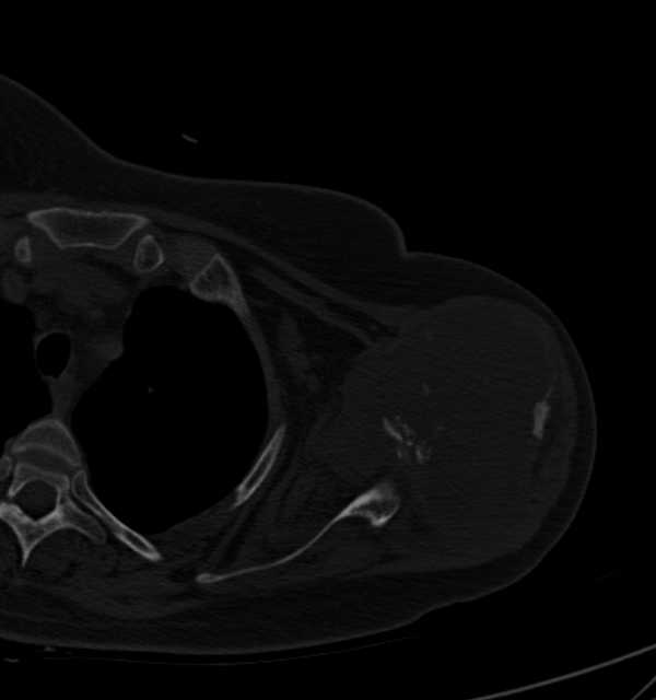Clear cell chondrosarcoma - humerus (Radiopaedia 63104-71612 Axial bone window 43).jpg