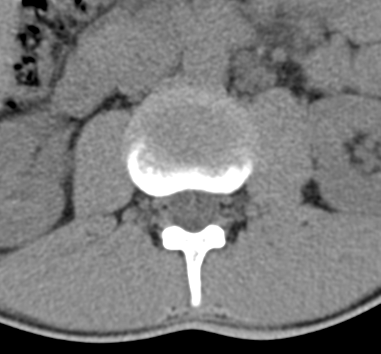 File:Clear cell meningoma - lumbar spine (Radiopaedia 60116-67691 Axial non-contrast 19).png