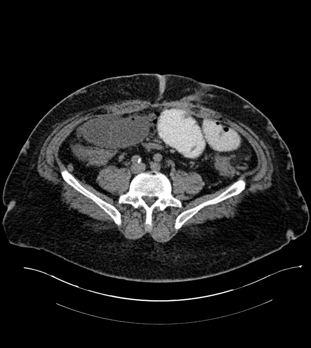 Closed-loop small bowel obstruction-internal hernia (Radiopaedia 78439-91096 Axial non-contrast 105).jpg