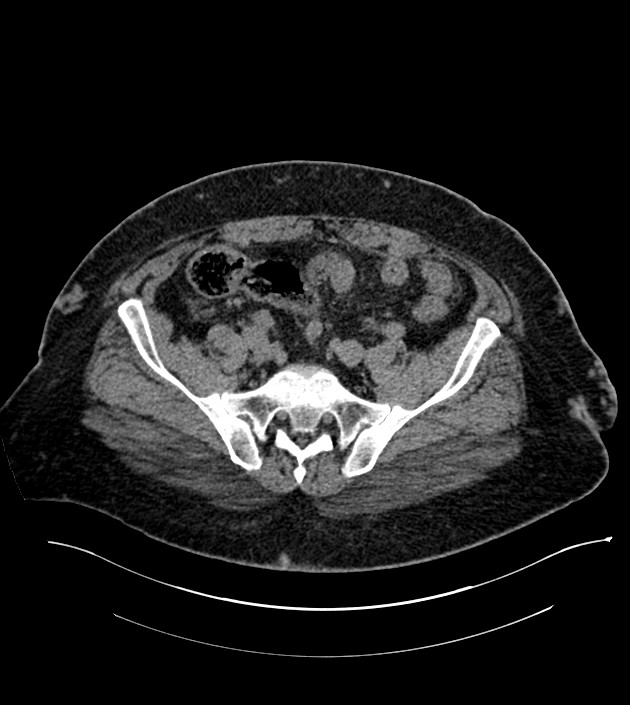 Closed-loop small bowel obstruction-internal hernia (Radiopaedia 78439-91096 Axial non-contrast 119).jpg