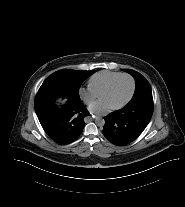 Closed-loop small bowel obstruction-internal hernia (Radiopaedia 78439-91096 Axial non-contrast 7).jpg