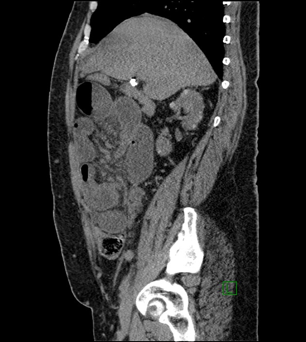Closed-loop small bowel obstruction-internal hernia (Radiopaedia 78439-91096 C 97).jpg