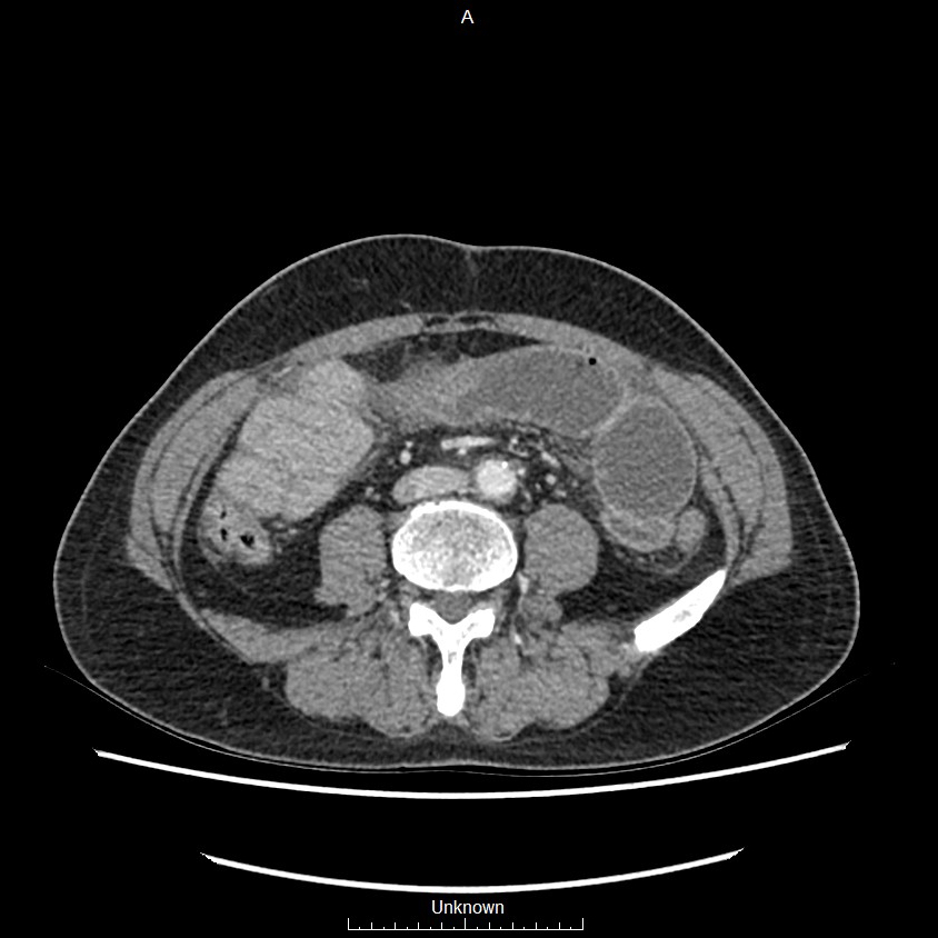 Closed loop bowel obstruction and ischemia (Radiopaedia 86959-103180 A 48).jpg