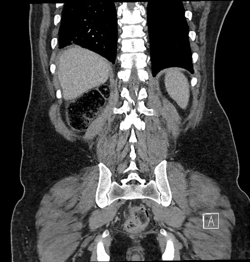 Closed loop obstruction - internal hernia into nephrectomy bed (Radiopaedia 59867-67320 B 114).jpg