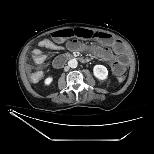 File:Closed loop obstruction due to adhesive band, resulting in small bowel ischemia and resection (Radiopaedia 83835-99023 Axial 407).jpg
