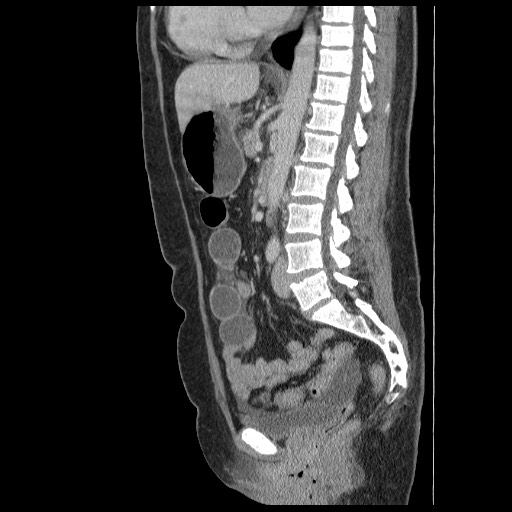 File:Closed loop small bowel obstruction (Radiopaedia 65403-74451 C 52).jpg