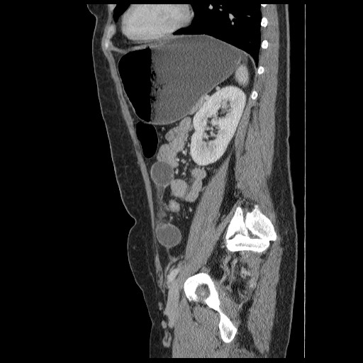 File:Closed loop small bowel obstruction (Radiopaedia 65403-74451 C 75).jpg