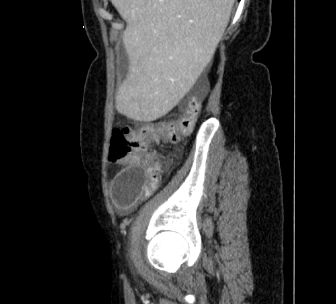 Closed loop small bowel obstruction (Radiopaedia 71211-81508 C 9).jpg