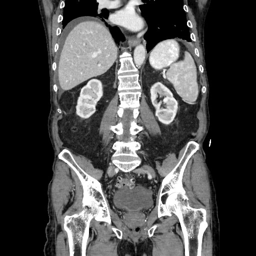 Closed loop small bowel obstruction - adhesive disease and hemorrhagic ischemia (Radiopaedia 86831-102990 B 84).jpg