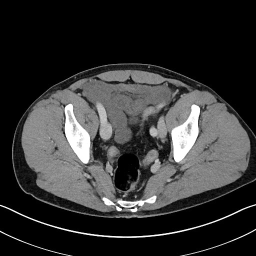 Closed loop small bowel obstruction - internal hernia (Radiopaedia 57806-64778 B 108).jpg