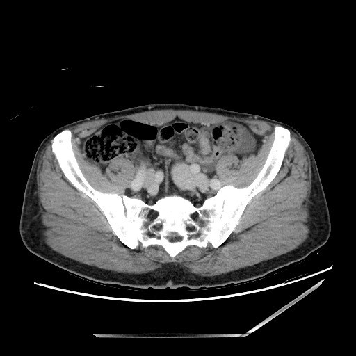 Closed loop small bowel obstruction - omental adhesion causing "internal hernia" (Radiopaedia 85129-100682 A 129).jpg